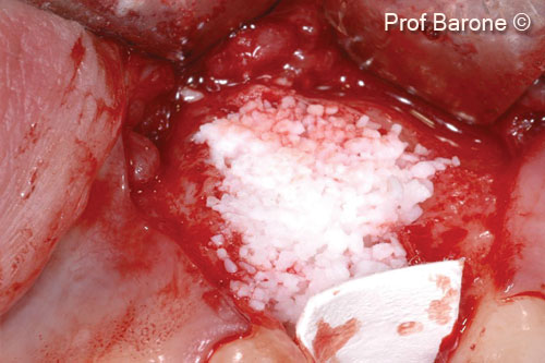 4. The bone defect was grafted with a corticocancellous porcine bone (mp3<sup>®</sup>) and the graft protected with a collagen membrane (Evolution)