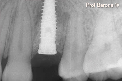 13. Peri-apical radiograph after implant placement