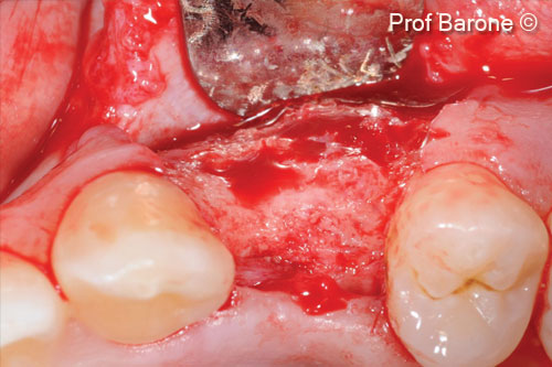 10. Bone regeneration 6 months after the ridge augmentation procedure, some residual particles are still visible, the biomaterial granules were well integrated in the new and well vascularized bone