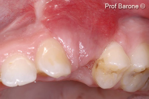 6. Soft tissue healing 6 weeks after the ridge augmentation procedure. Buccal view