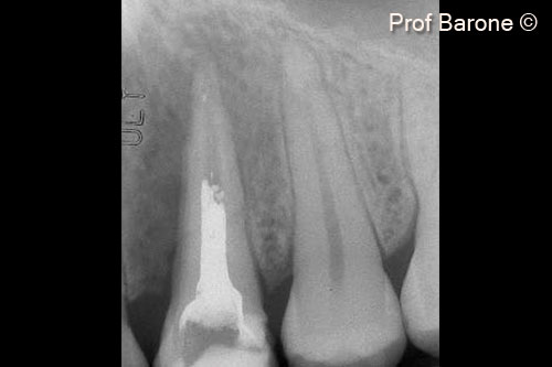 1. Pre-operative periapical radiograph tooth #24