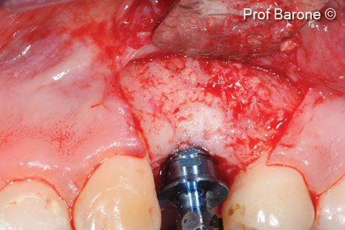 12. Implant placement, buccal view. The newly formed bone appeared well vascularized