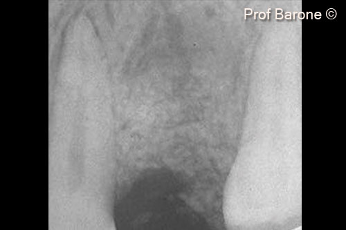 9. Periapical radiograph tooth #24 6 months after ridge augmentation procedure