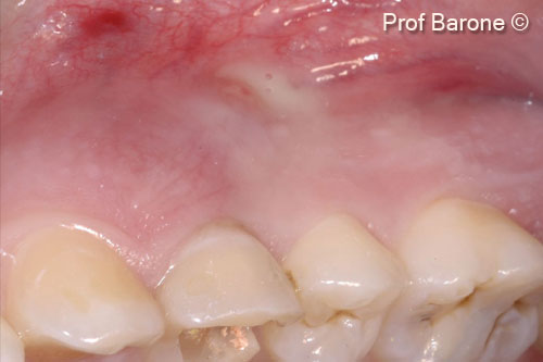 2. Clinical view. Acute infection, suppuration from a buccal fistula, mesial and distal probing depth 12mm, buccal probing depth 15mm and mobility degree 3