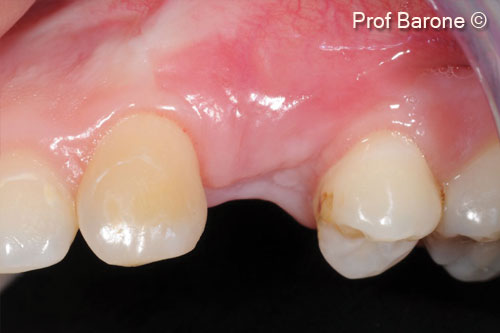 8. Soft tissue healing 6 months after the ridge augmentation procedure, the muco-gingival junction was displaced coronally. Buccal view