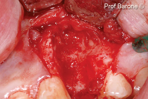 3. Intra-operative view, full thickness flap was elevated, the tooth was extracted and a severe bone defect was present