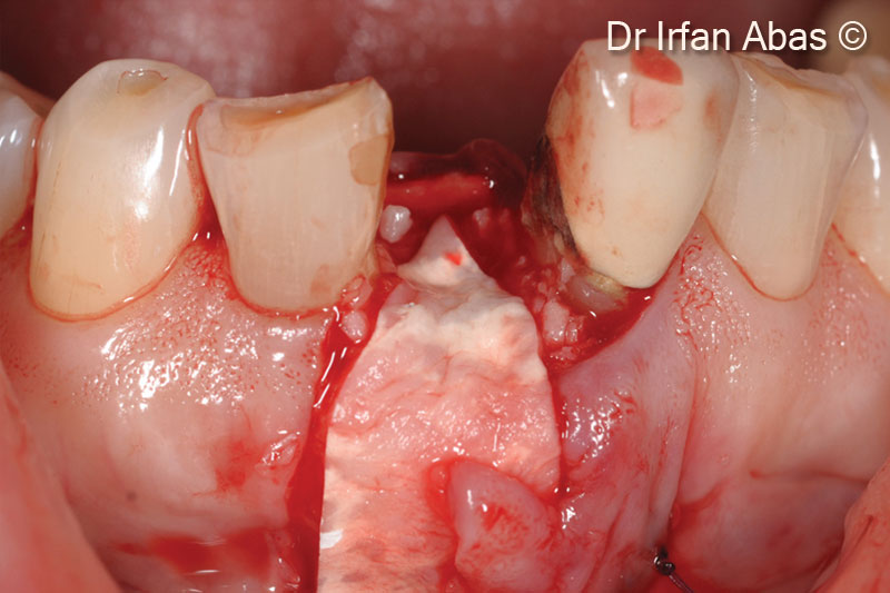 Socket grafting and delayed implant...