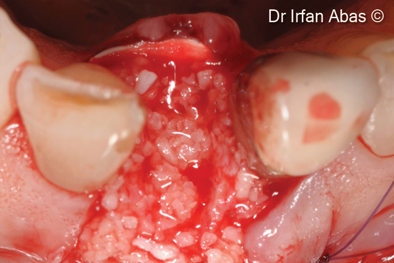 6. Graft - labial