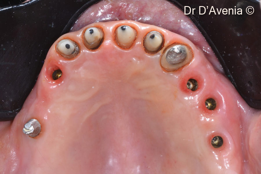 15. Final zirconia restorations. Implant supported screwed crowns for treated sites