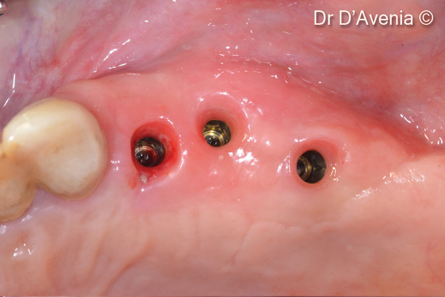 14.  8 weeks healing, at the time of provisonal restoration application