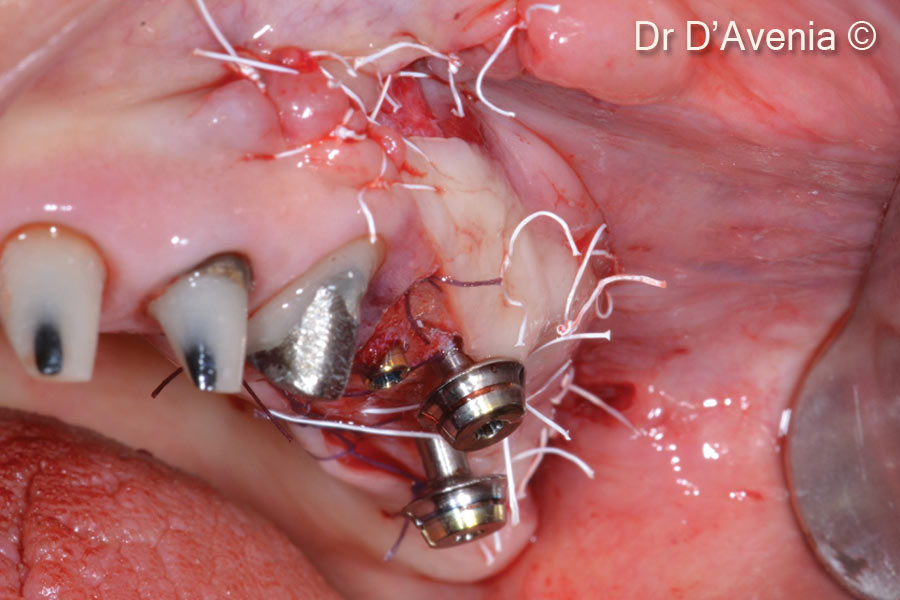 10. The partial thickness flap is repositioned apically, buccally and mesially, in order to provide adequate keratinezed tissue buccally