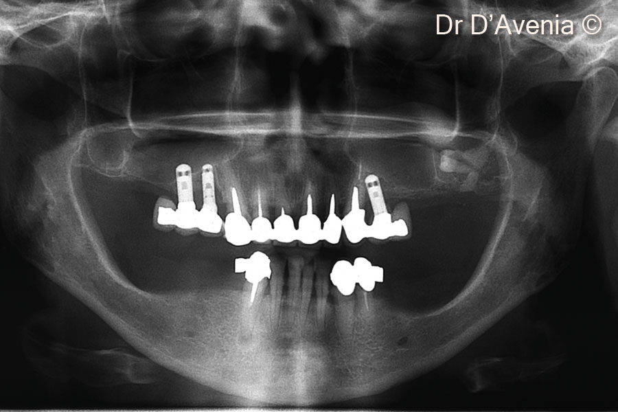 1. Baseline OPT: note retained tooth 28 inside sinus