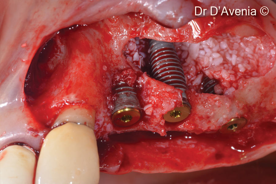 Sinus Graft combined with 3D alveolar...