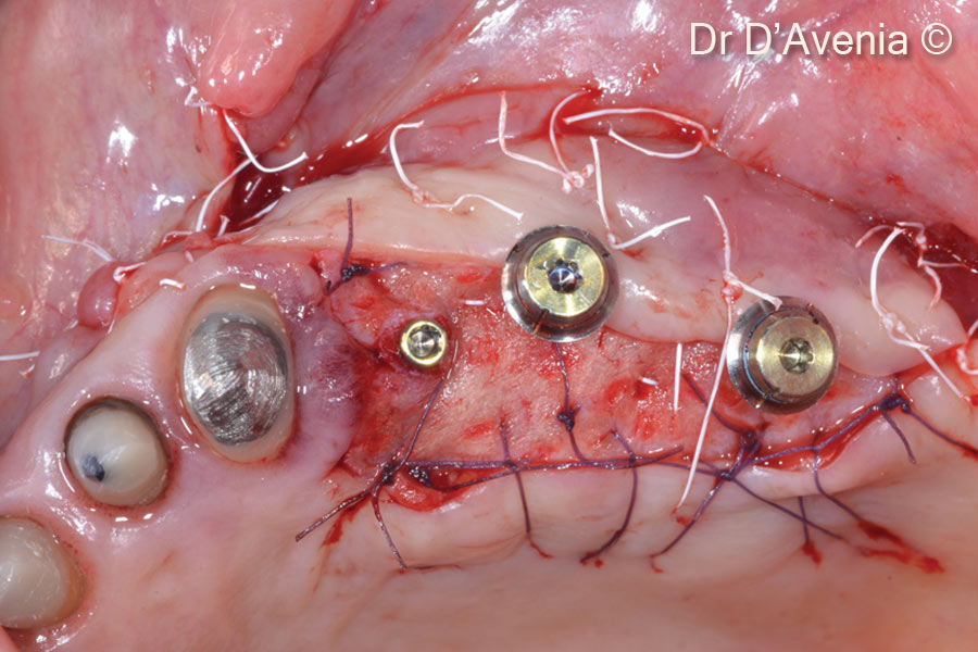 12. The partial thickness flap is repositioned apically, buccally and mesially, in order to provide adequate keratinezed tissue buccally