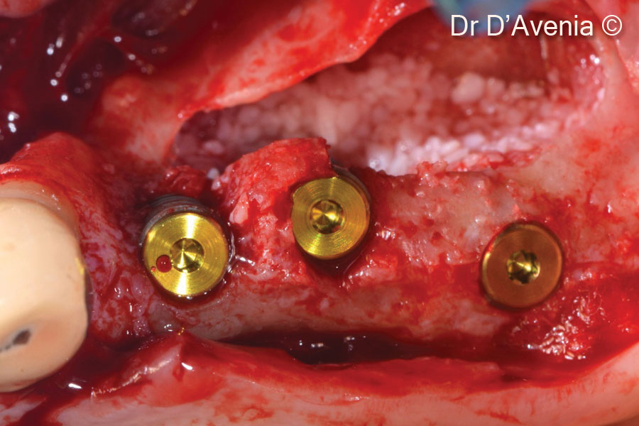 4. mp3<sup>®</sup> graft material (first layer) and implant placement