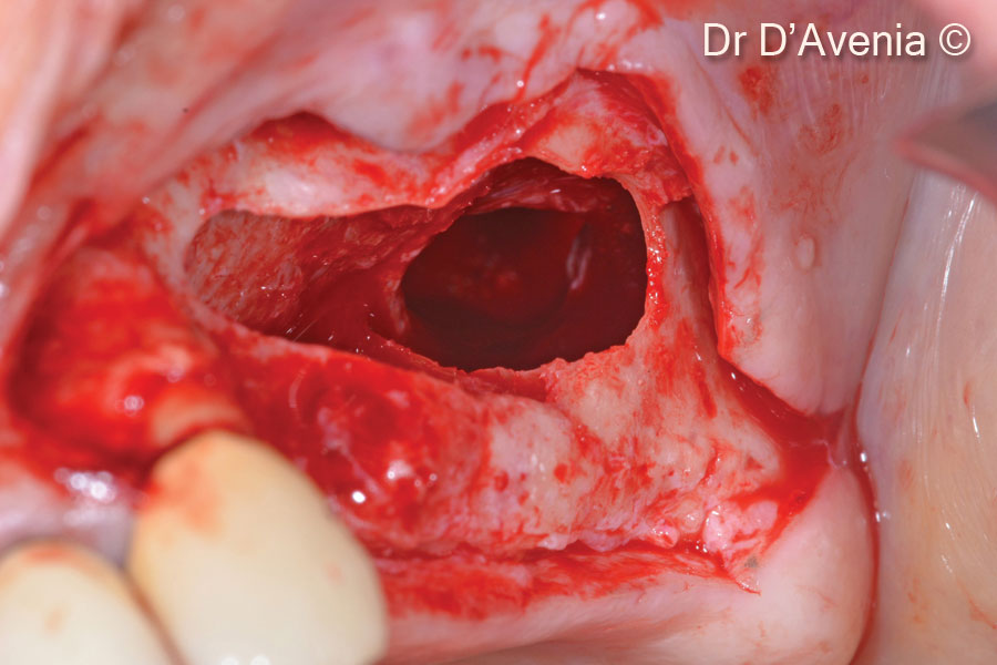2. Access flap and antrostomy