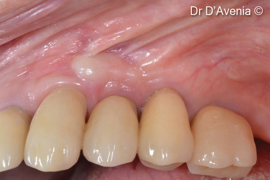 17.  Final zirconia restorations. Implant supported screwed crowns for treated sites