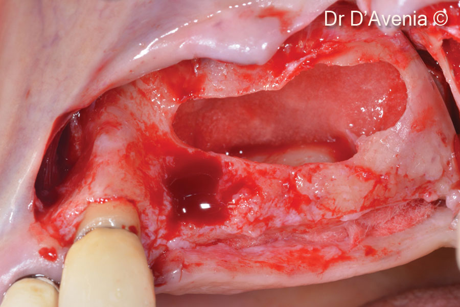 3. Schneiderian membrane protection with collagen sponge
