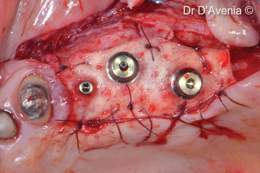 9. Derma graft for connective tissue protection