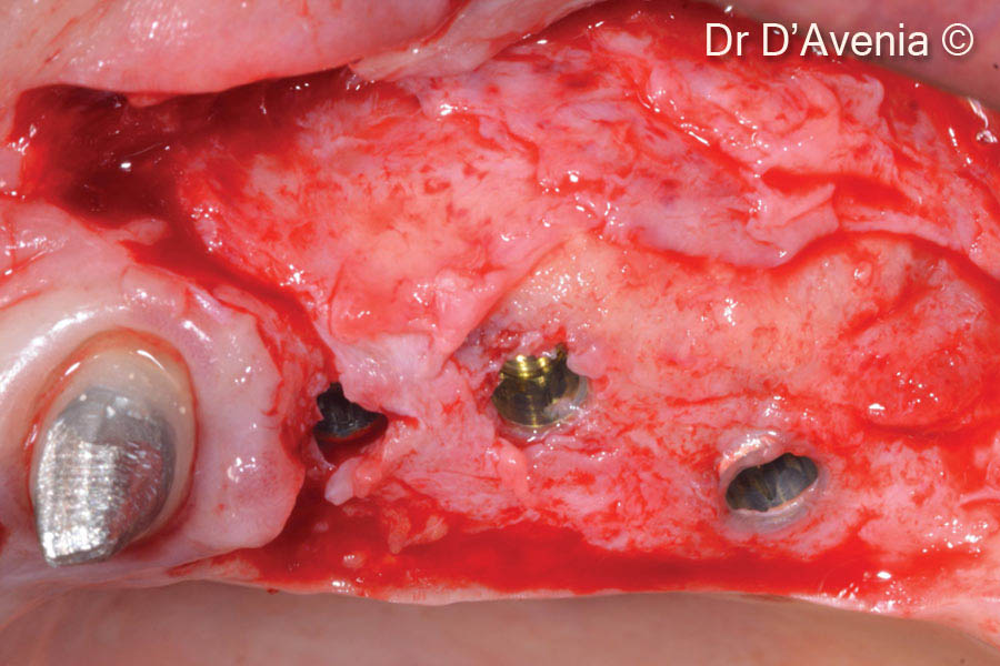 8. Partial thickness access flap for implant uncovering