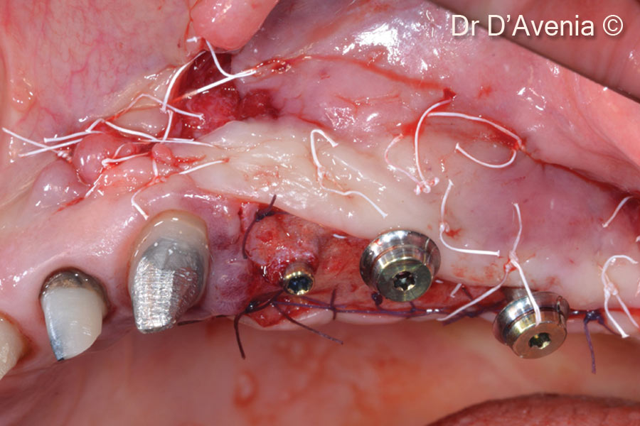 11. The partial thickness flap is repositioned apically, buccally and mesially, in order to provide adequate keratinezed tissue buccally