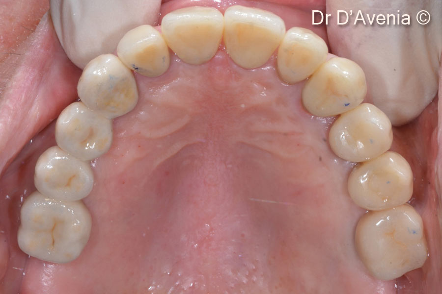 16. Final zirconia restorations. Implant supported screwed crowns for treated sites