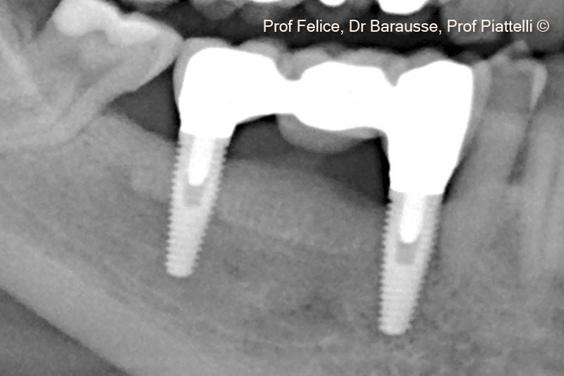 15. X-ray with definitive proshtesis after 5 years