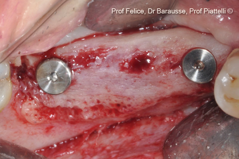 11. Implants placed during the re-entry surgery