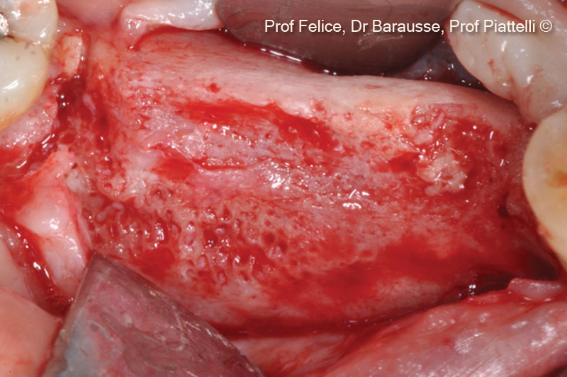 9. Clinical image of the re-entry surgery before implants positioning after 3 months