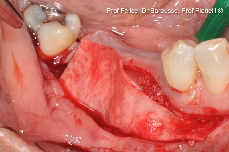 8.  A resorbable membrane was applied on the vestibular surgical side