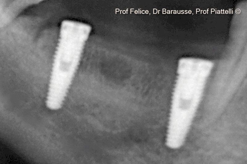 12. X-ray after implant positioning