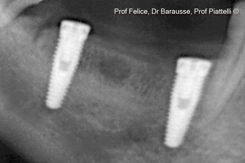 12. X-ray after implant positioning