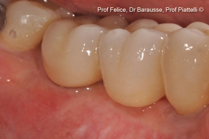 13. Clinical image of the definitive prosthesis after 1 year