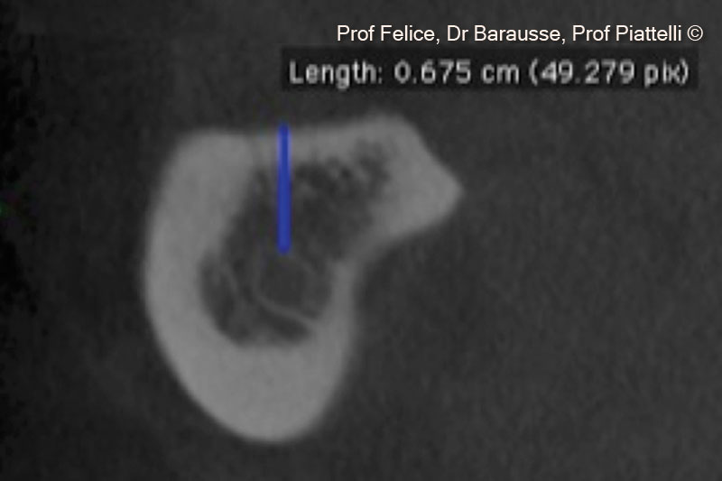 3. CT cross section revealing the vertical crestal atrophy