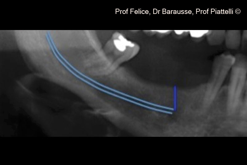 2. Pre-operative x-ray of the atrophic posterior right mandible
