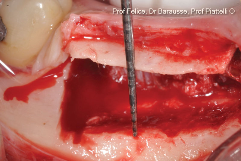 6. The osteotomized segment was raised coronally
