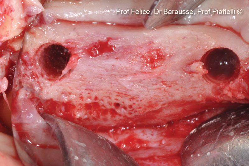10. Implant tunnel preparations in the regenerated bone