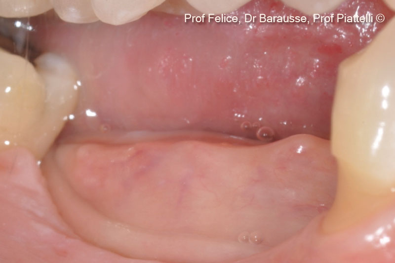 1. Pre-operative clinical image of an atrophic posterior right mandible