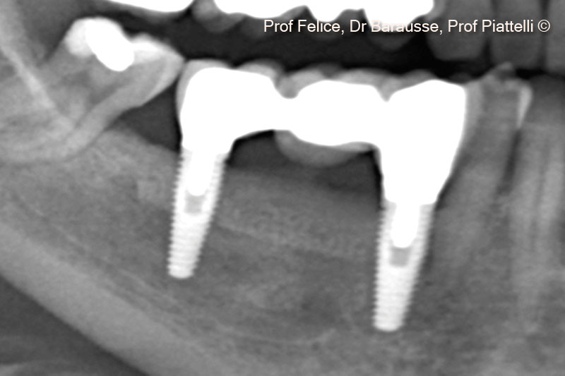 14. X-ray with definitive proshtesis after 3 years