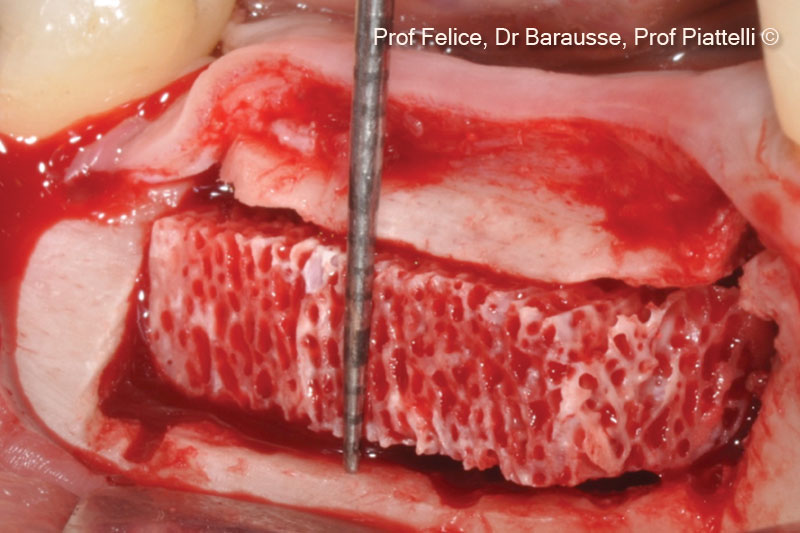 Interpositional block bone graft...