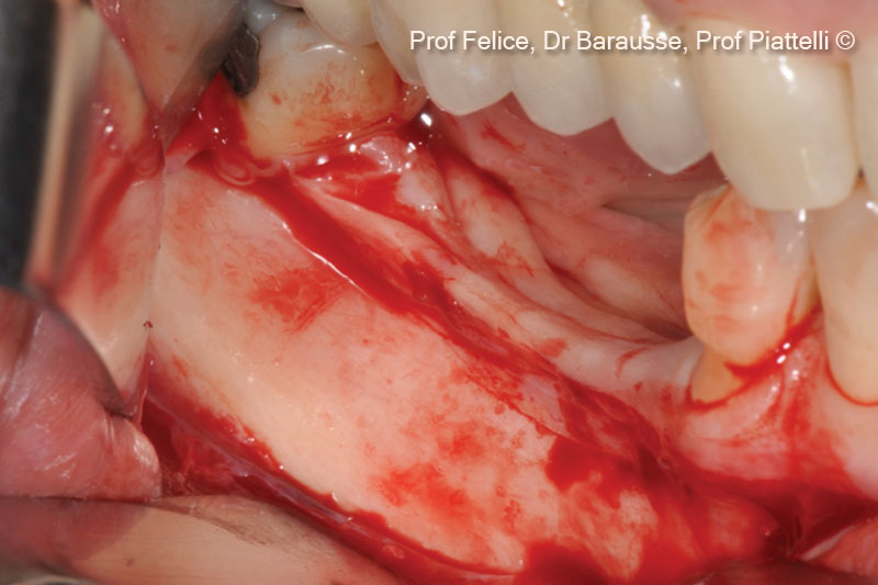  4. After performing a paracrestal incision in the buccal aspect, a flap was carefully elevated