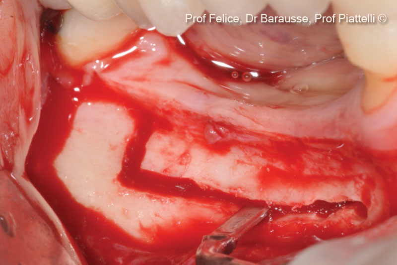 5. Horizontal and vertical osteotomy lines