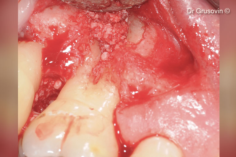 Treatment of upper molar furcation III...