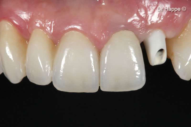 14.  X-ray 4 months after implant placement