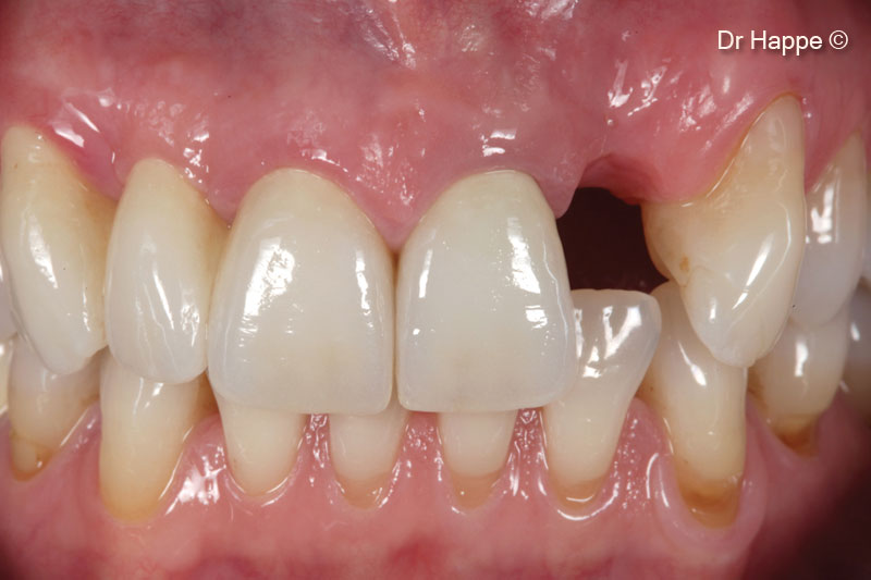 3. Situation 8 weeks after extraction