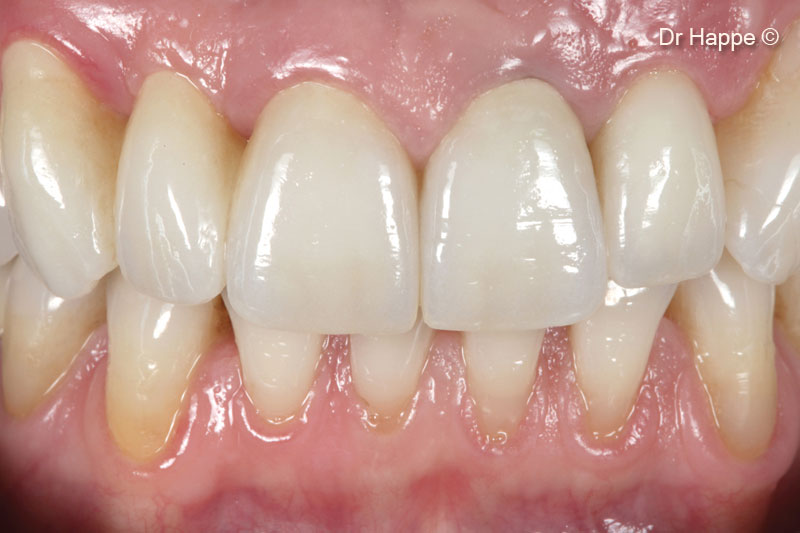 15.  Final result 1 year after placement of the final all-ceramic restoration