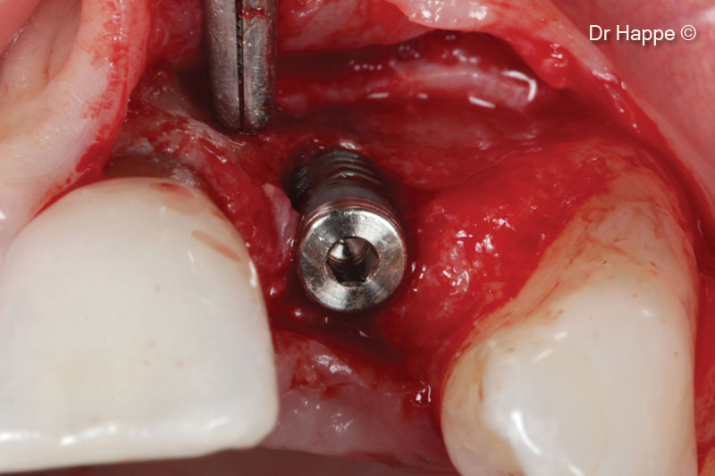 5. 3.3 diameter implant in place. Buccal dehiscency defect