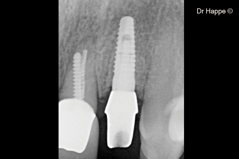 13.  Zirconia abutment in place