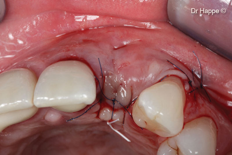 8. Wound closure. Only one distal releasing incision was performed