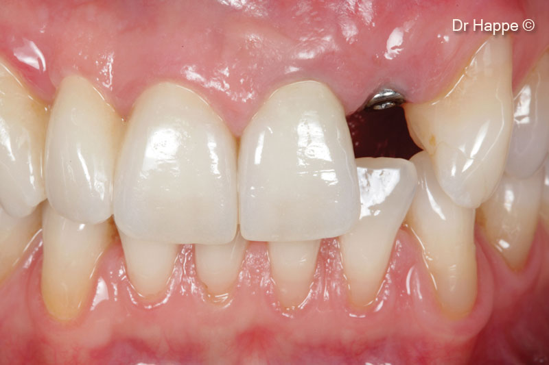 12. Situation prior to the restorative phase